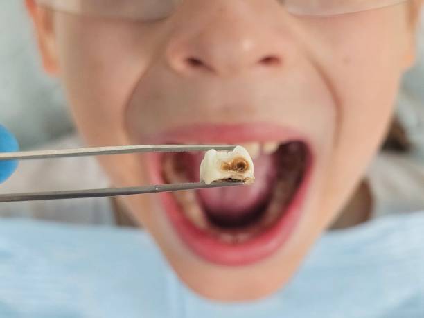 Best Emergency Wisdom Teeth Removal in Bartlett, IL